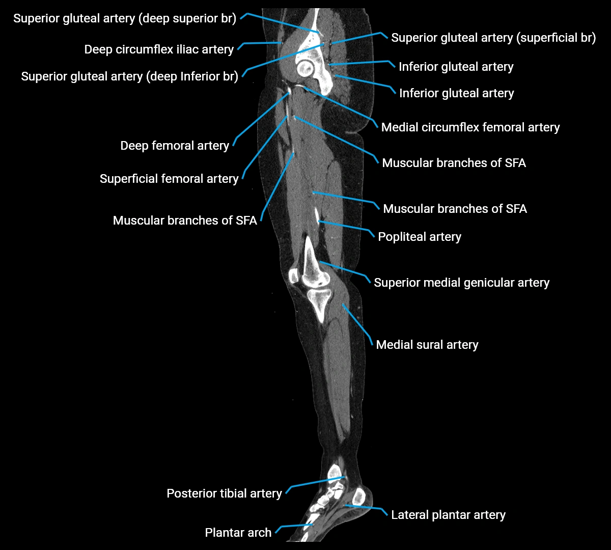 CTA lower limb sagittal cross sectional anatomy labelled image _34 (3).webp